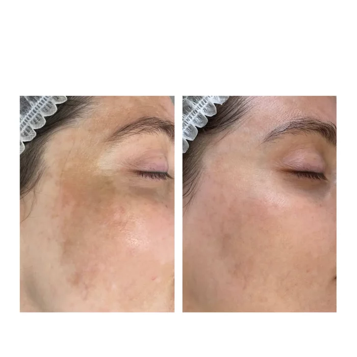 Лечение пигментации