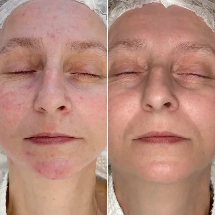 Лечение розацеа