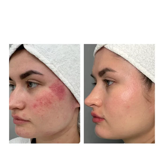 Лечение розацеа