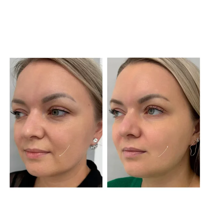 Ультраформер