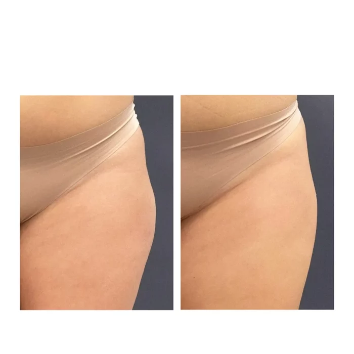 Ультраформер