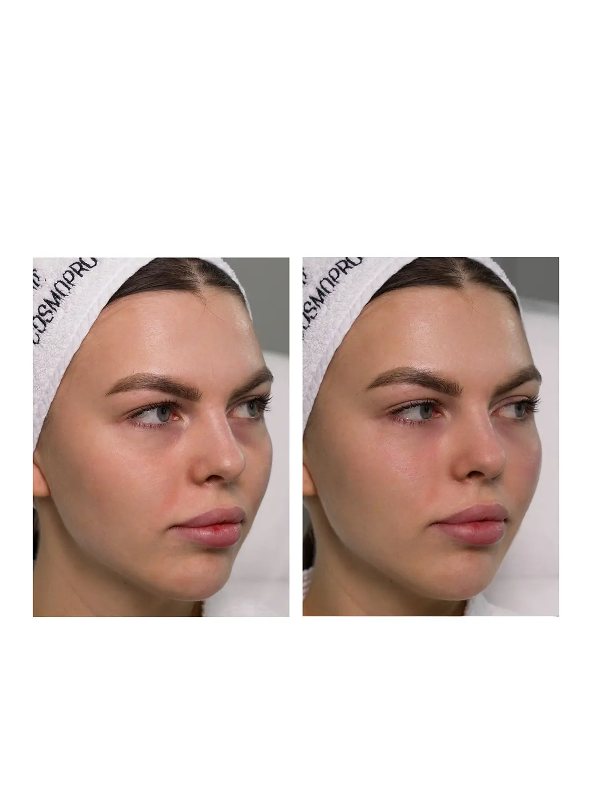 Заполнение насослезной борозды